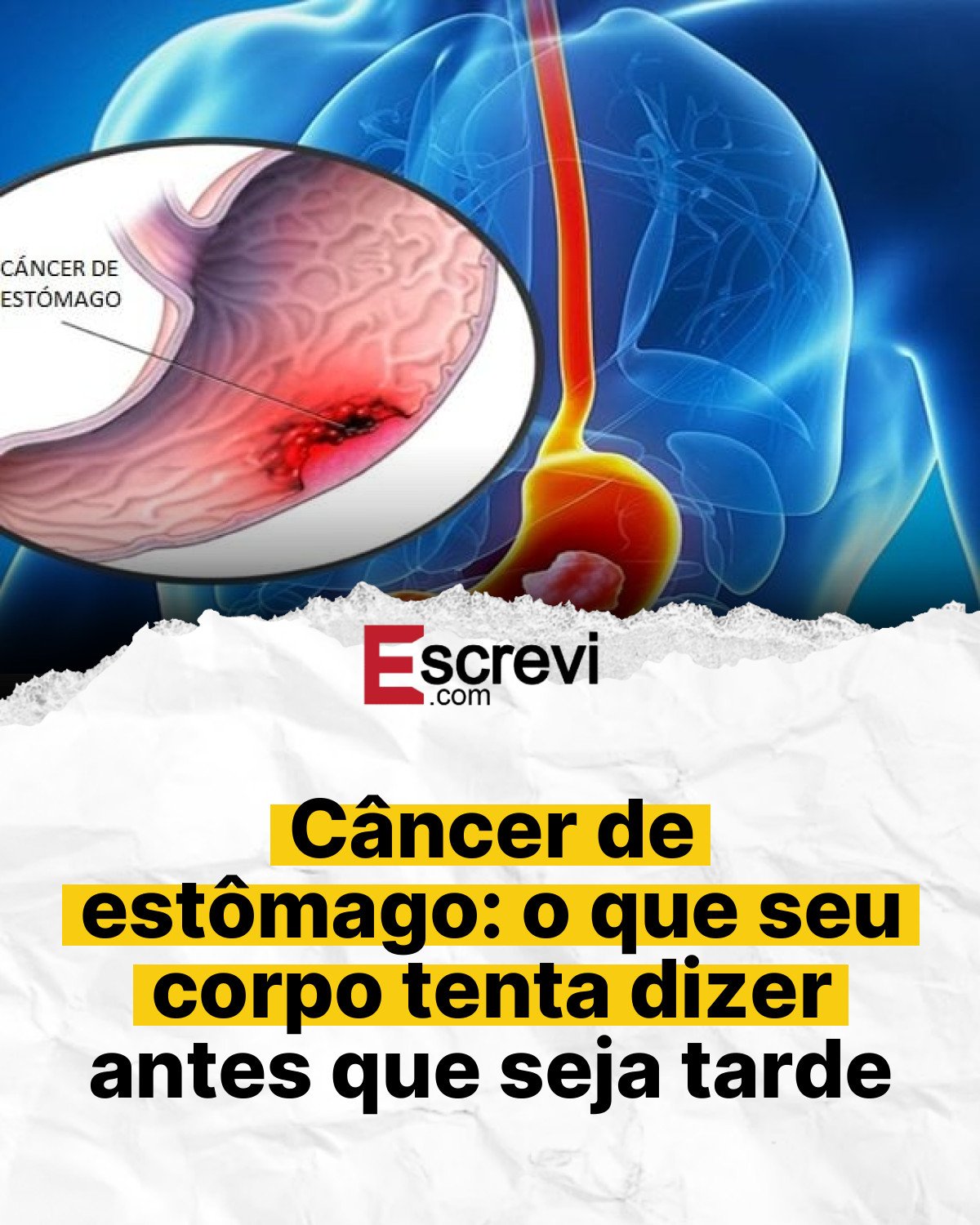 Câncer de estômago: o que seu corpo tenta dizer antes que seja tarde card branco