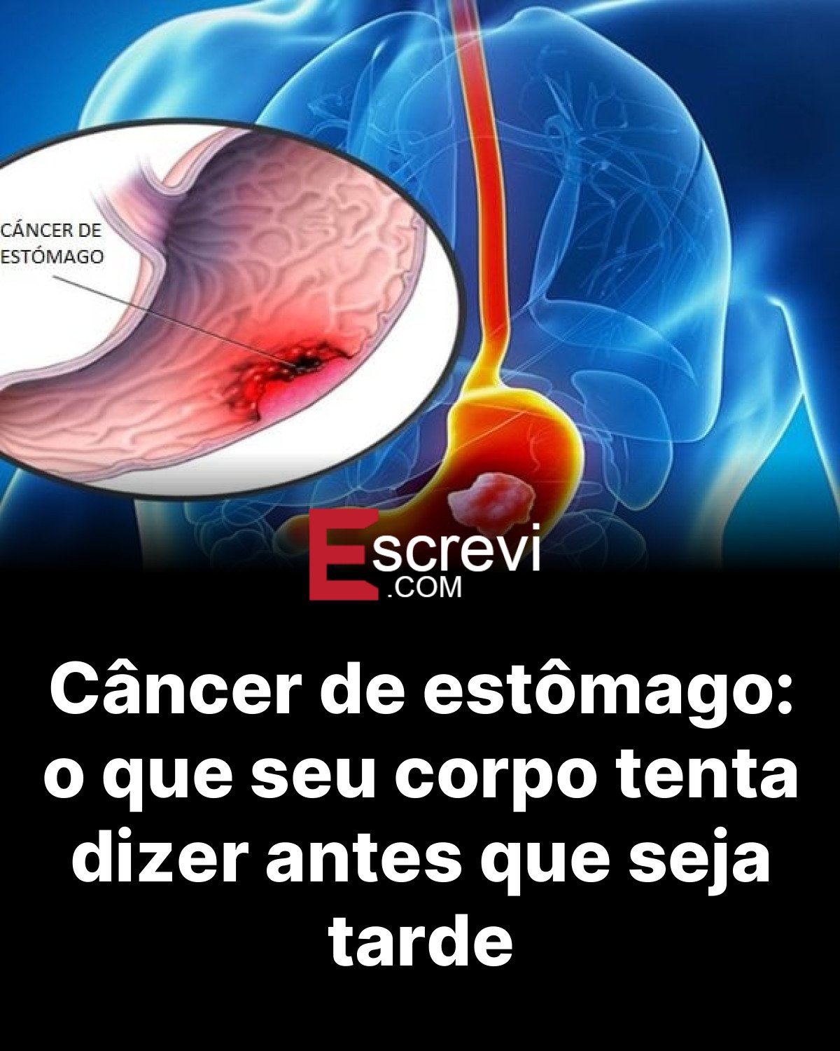 Câncer de estômago: o que seu corpo tenta dizer antes que seja tarde card preto