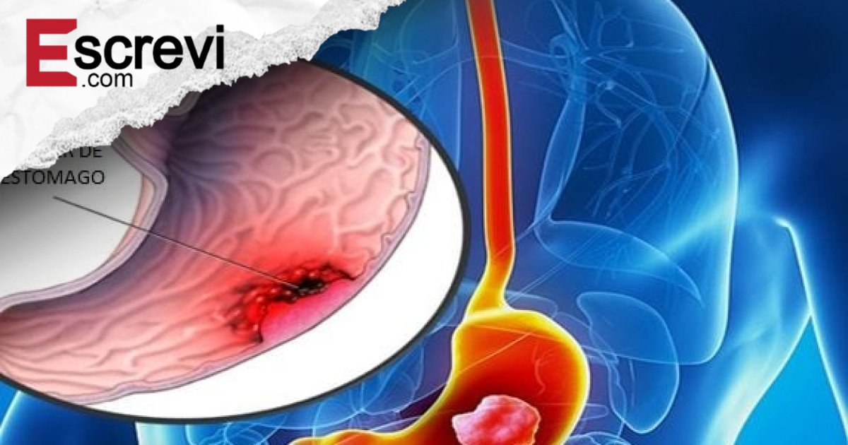 Câncer de estômago: o que seu corpo tenta dizer antes que seja tarde imagem principal
