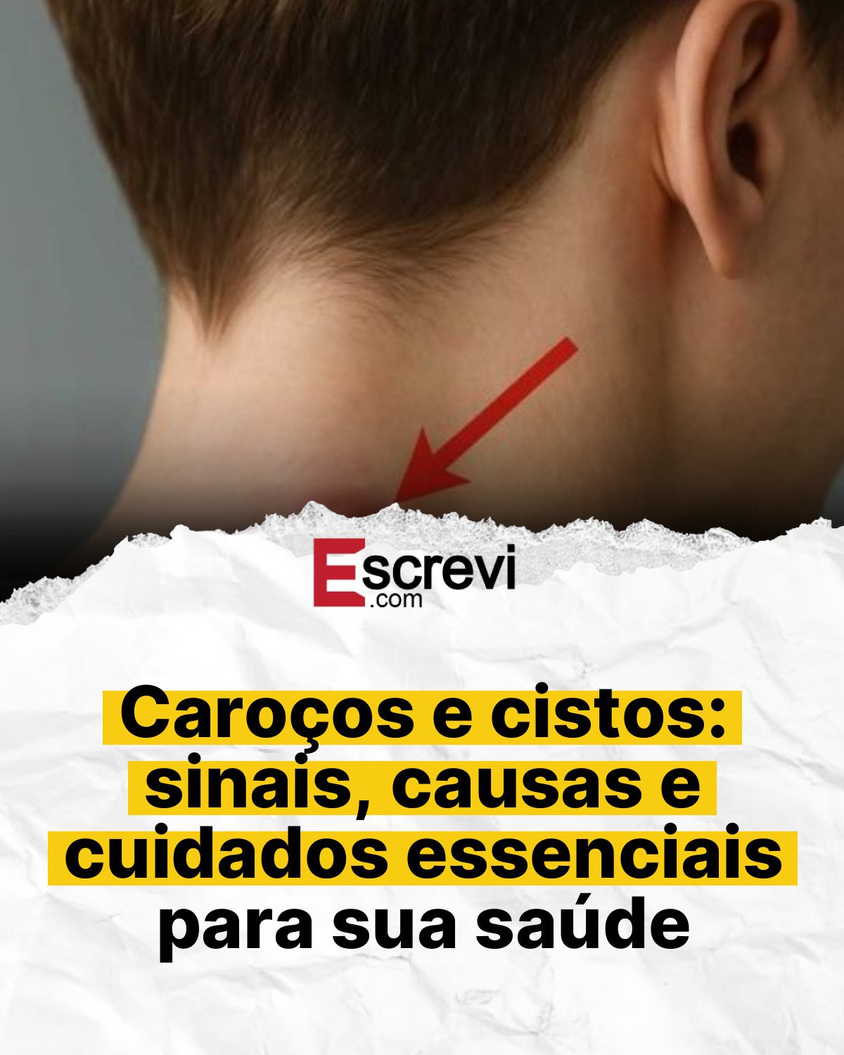 Caroços e cistos: sinais, causas e cuidados essenciais para sua saúde card branco