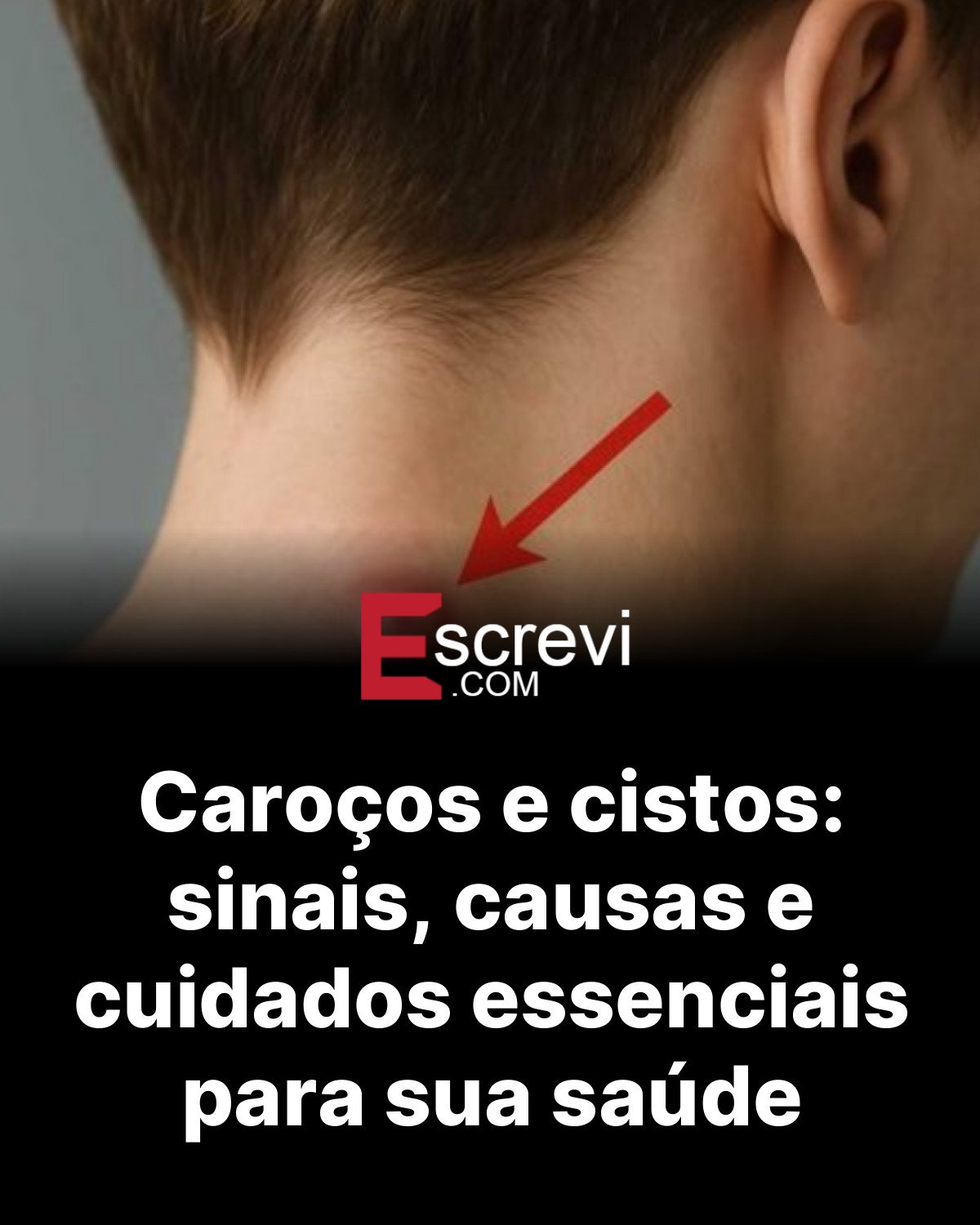 Caroços e cistos: sinais, causas e cuidados essenciais para sua saúde card preto