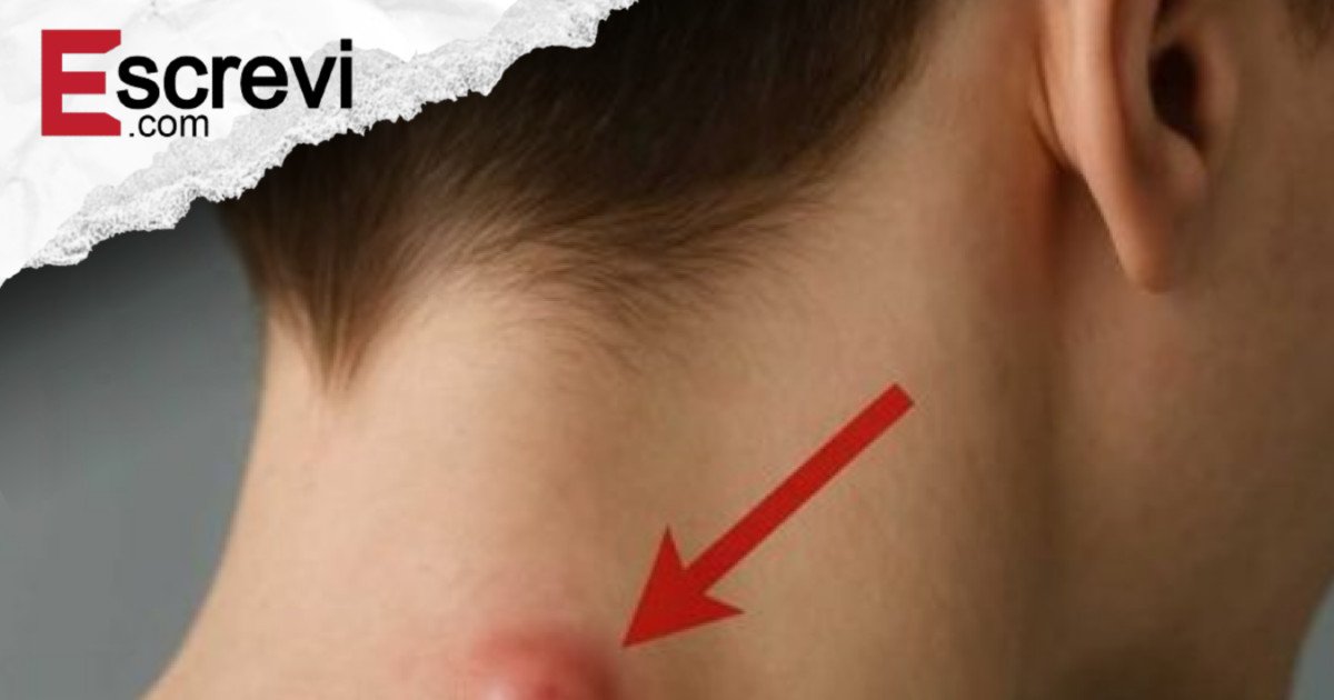 Caroços e cistos: sinais, causas e cuidados essenciais para sua saúde imagem principal