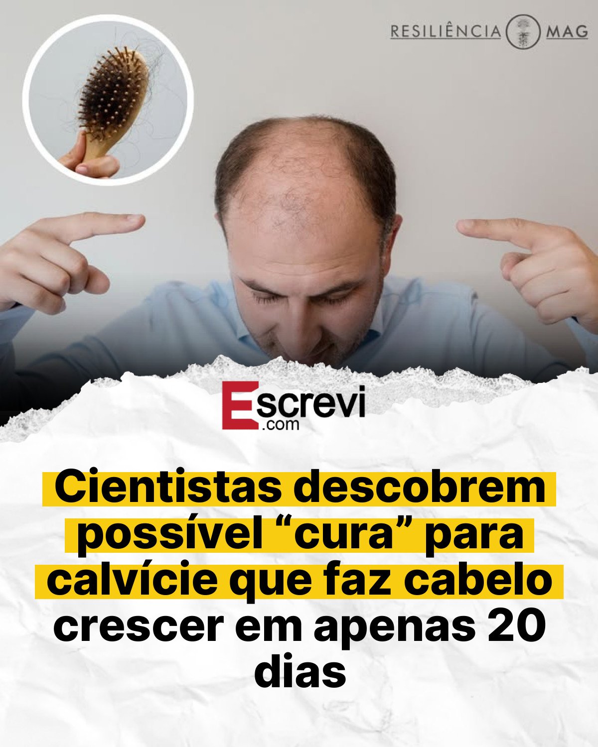 Cientistas descobrem possível “cura” para calvície que faz cabelo crescer em apenas 20 dias card branco