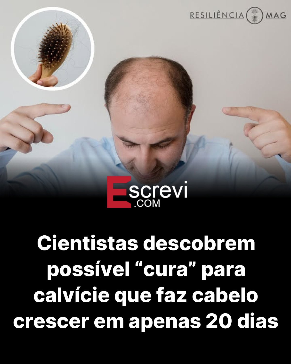 Cientistas descobrem possível “cura” para calvície que faz cabelo crescer em apenas 20 dias card preto