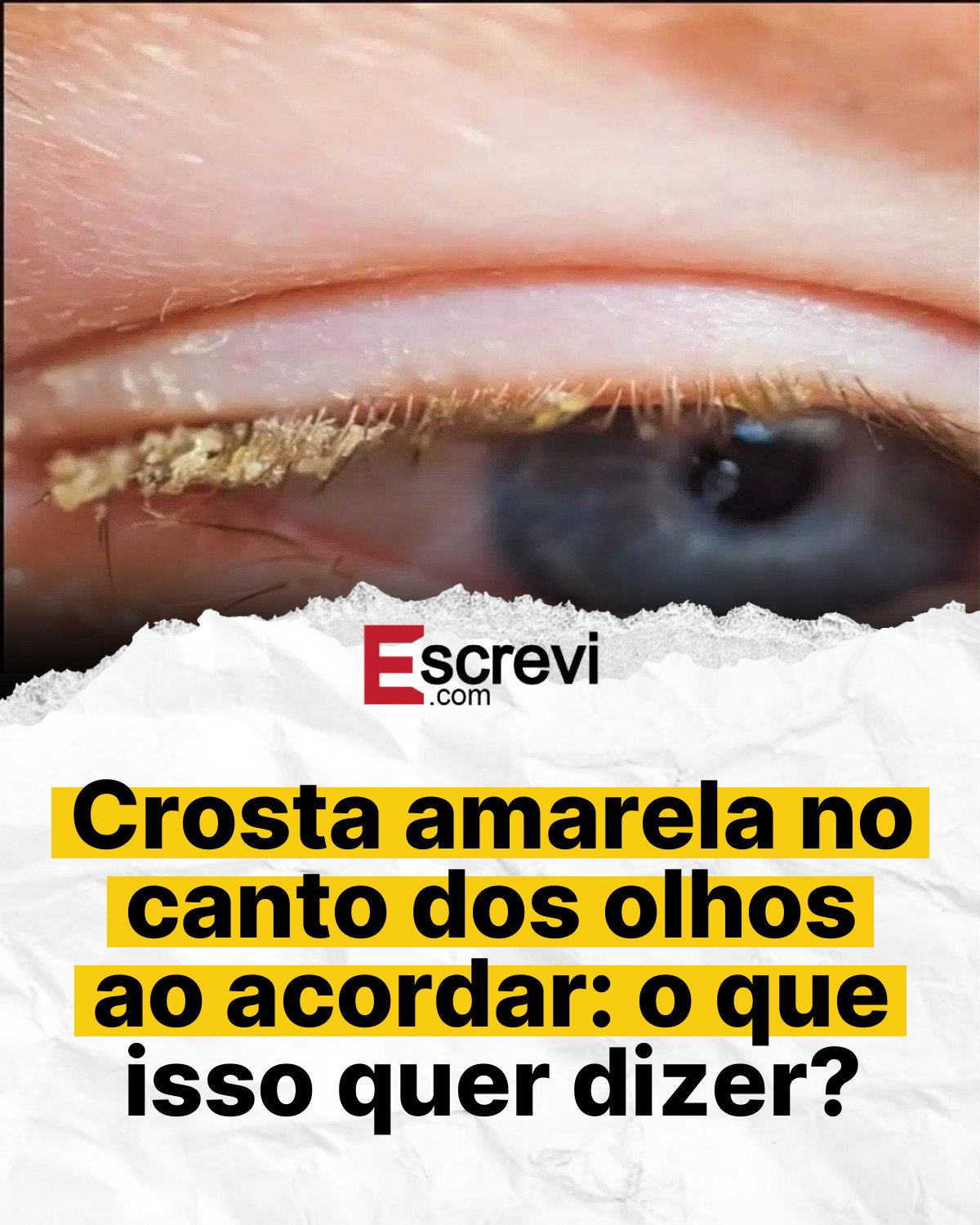 Crosta amarela no canto dos olhos ao acordar: o que isso quer dizer? card branco