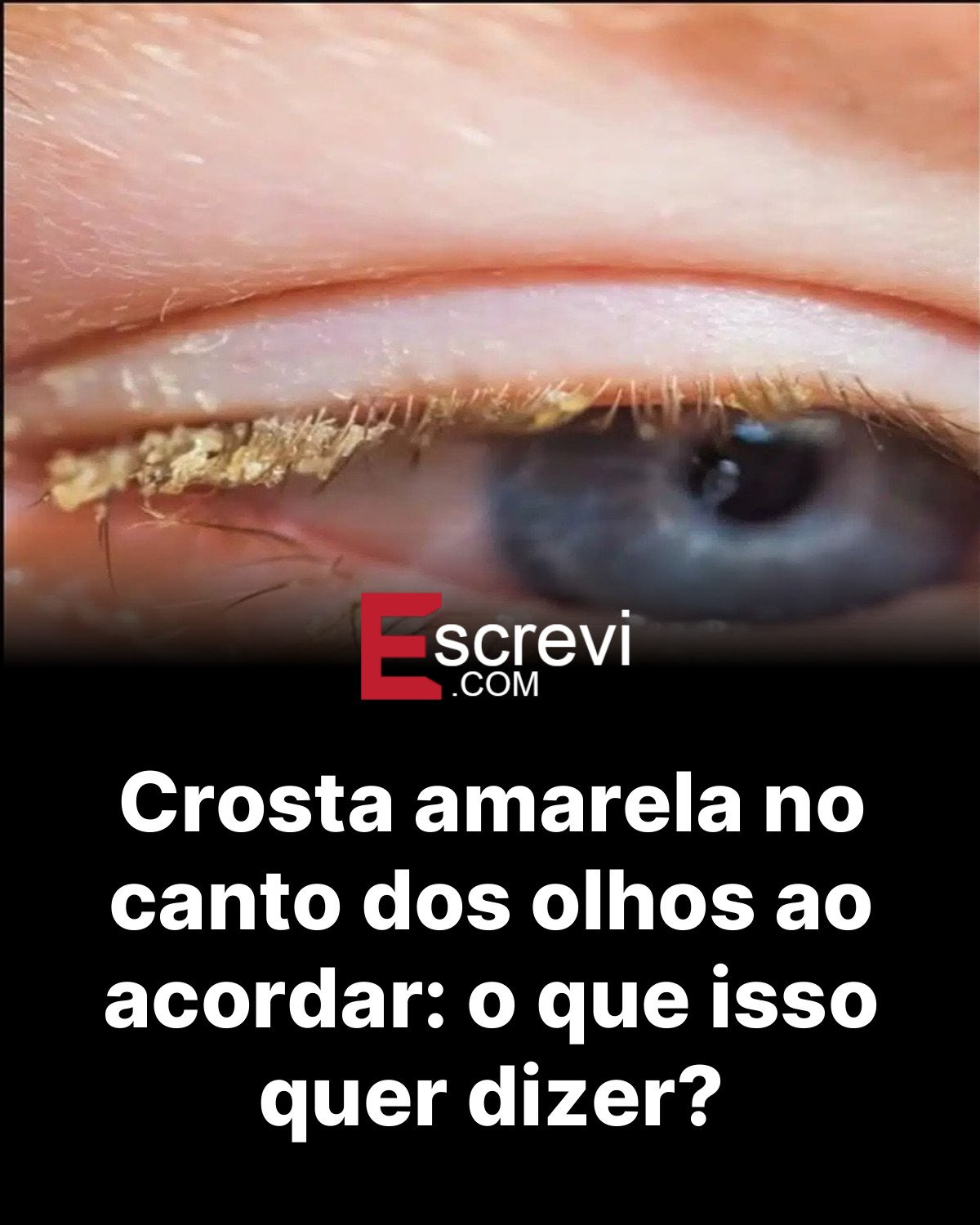 Crosta amarela no canto dos olhos ao acordar: o que isso quer dizer? card preto
