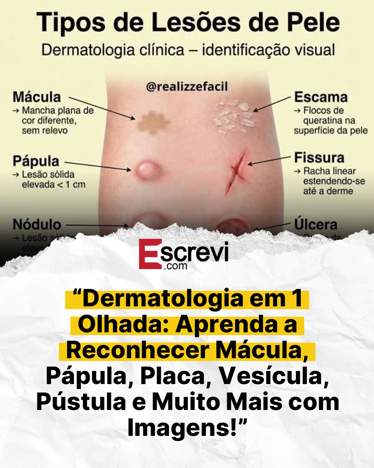 “Dermatologia em 1 Olhada: Aprenda a Reconhecer Mácula, Pápula, Placa, Vesícula, Pústula e Muito Mais com Imagens!” card branco