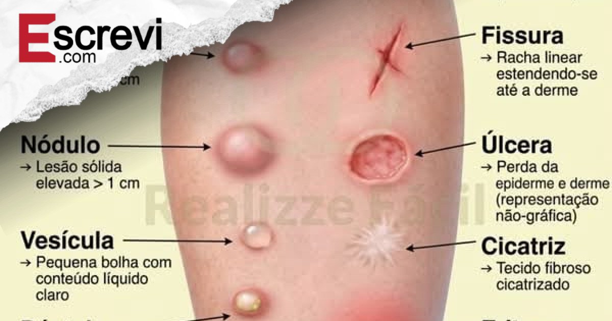 “Dermatologia em 1 Olhada: Aprenda a Reconhecer Mácula, Pápula, Placa, Vesícula, Pústula e Muito Mais com Imagens!” imagem principal
