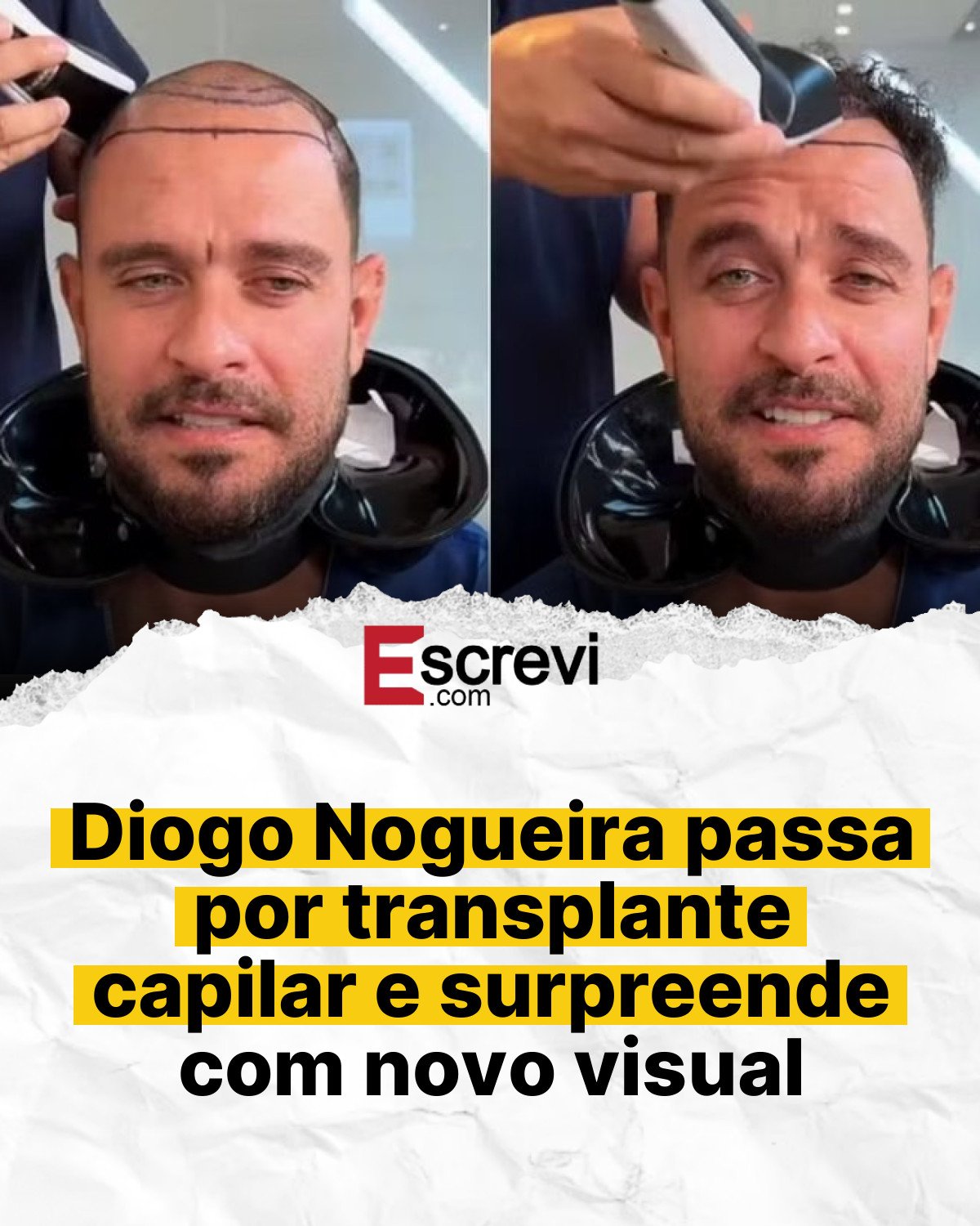 Diogo Nogueira passa por transplante capilar e surpreende com novo visual card branco
