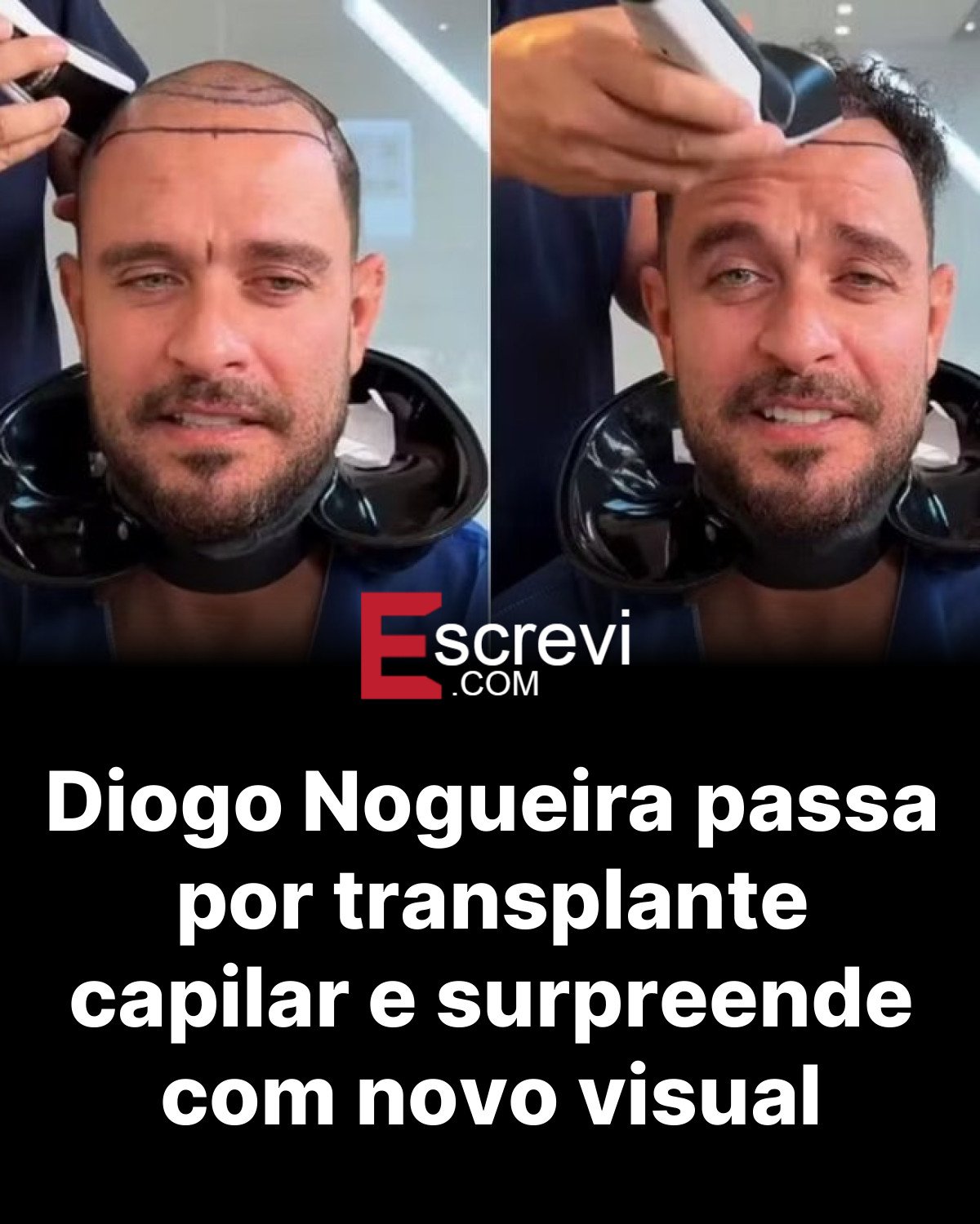 Diogo Nogueira passa por transplante capilar e surpreende com novo visual card preto