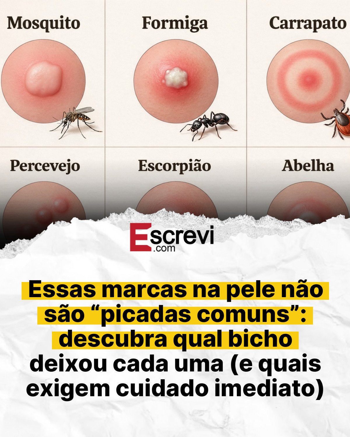 Essas marcas na pele não são “picadas comuns”: descubra qual bicho deixou cada uma (e quais exigem cuidado imediato) card branco