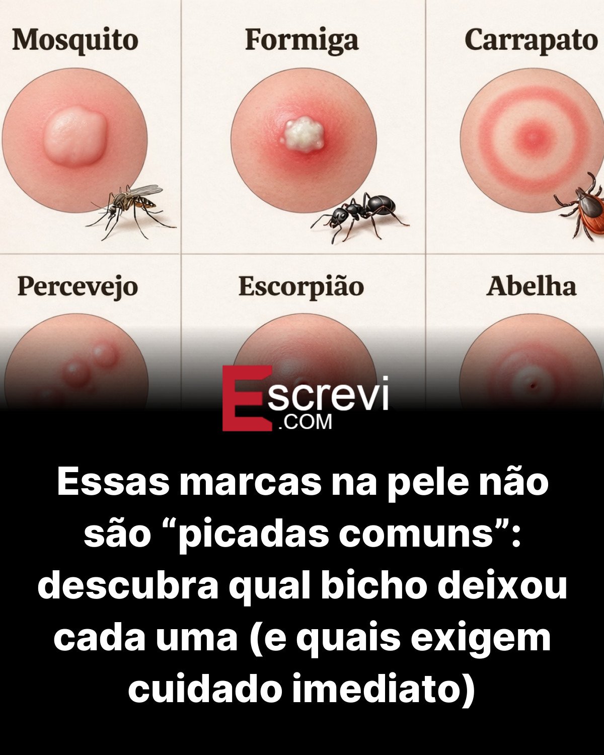 Essas marcas na pele não são “picadas comuns”: descubra qual bicho deixou cada uma (e quais exigem cuidado imediato) card preto