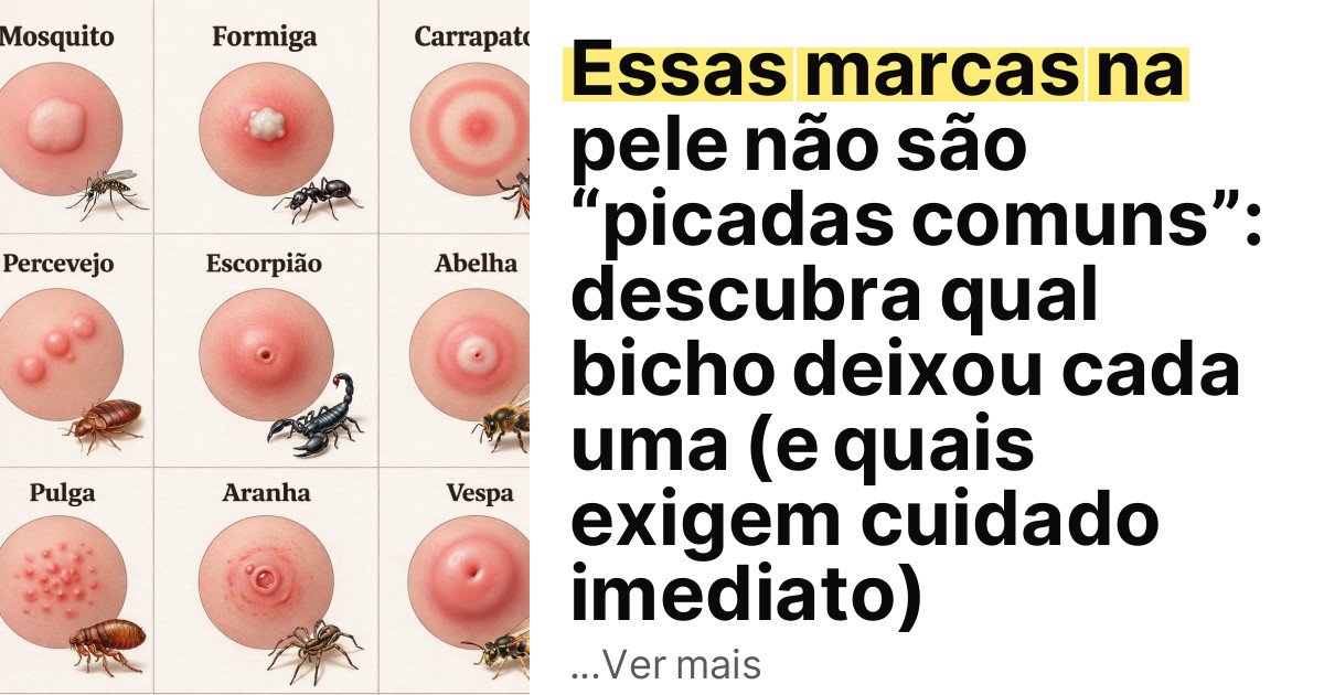 Essas marcas na pele não são “picadas comuns”: descubra qual bicho deixou cada uma (e quais exigem cuidado imediato) imagem principal