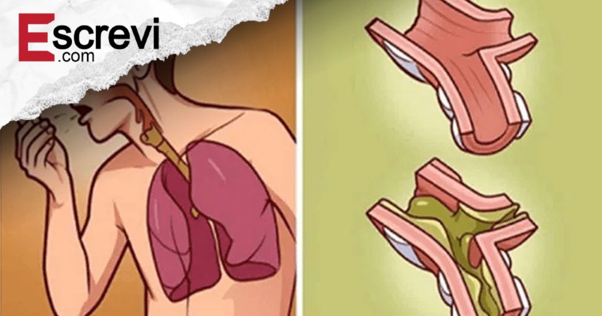 Felizmente, há diversas medidas que você pode fazer em casa para ajudar a eliminar o catarro e respirar melhor imagem principal