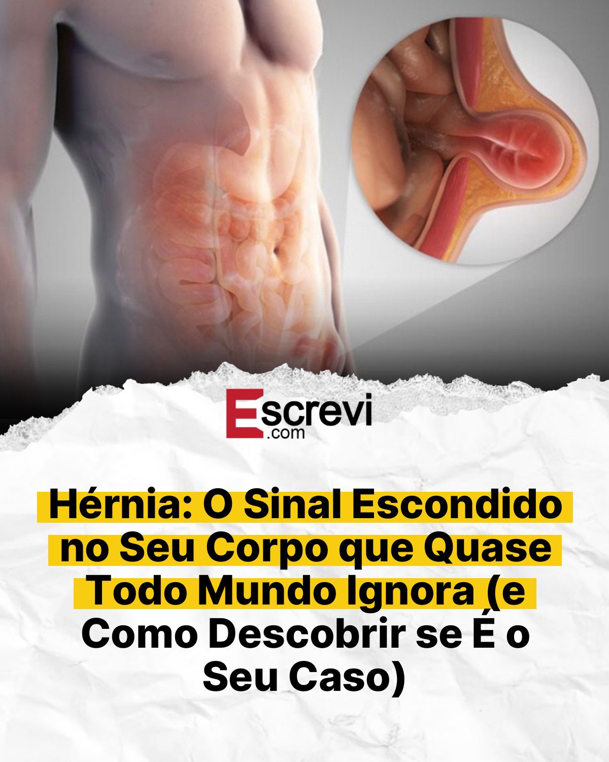 Hérnia: O Sinal Escondido no Seu Corpo que Quase Todo Mundo Ignora (e Como Descobrir se É o Seu Caso) card branco