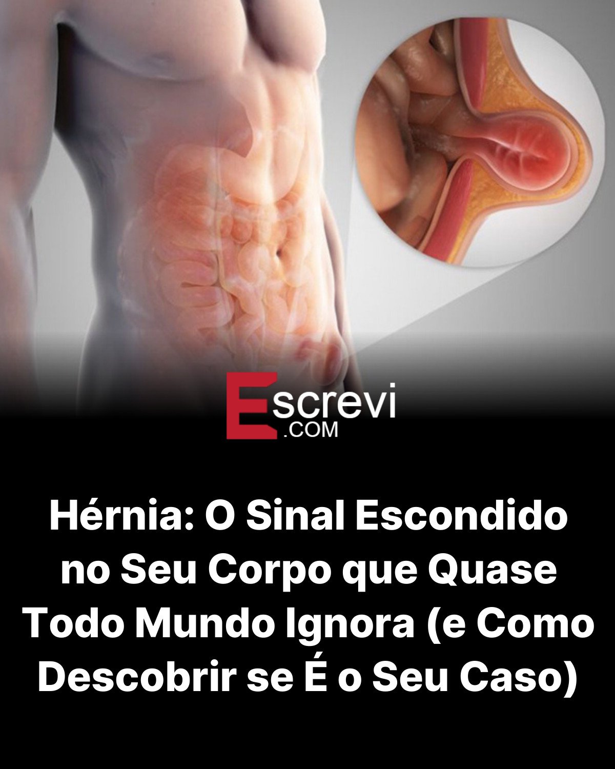 Hérnia: O Sinal Escondido no Seu Corpo que Quase Todo Mundo Ignora (e Como Descobrir se É o Seu Caso) card preto