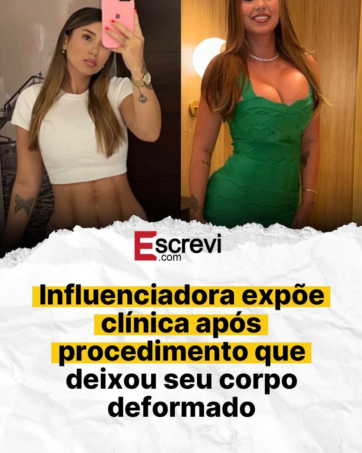Influenciadora expõe clínica após procedimento que deixou seu corpo deformado card branco