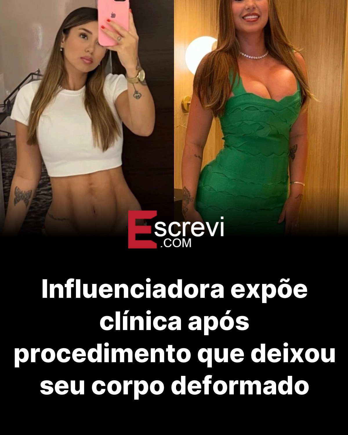 Influenciadora expõe clínica após procedimento que deixou seu corpo deformado card preto