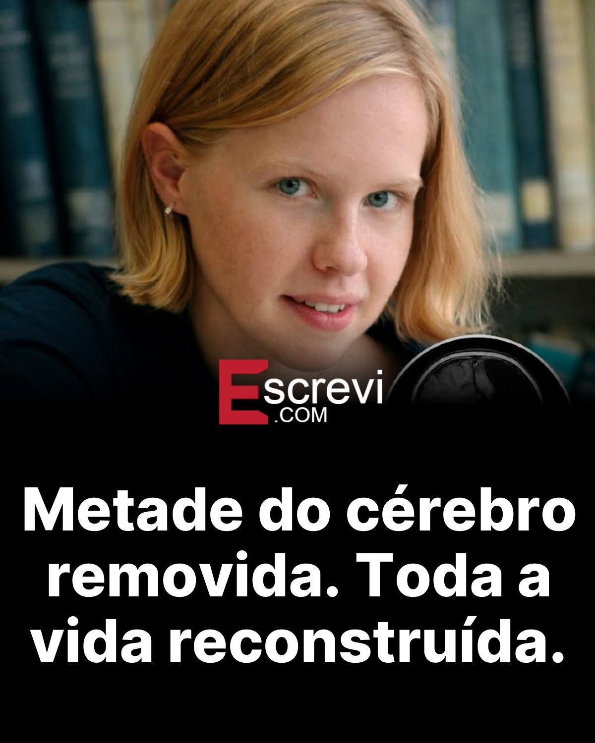 Metade do cérebro removida. Toda a vida reconstruída. card preto