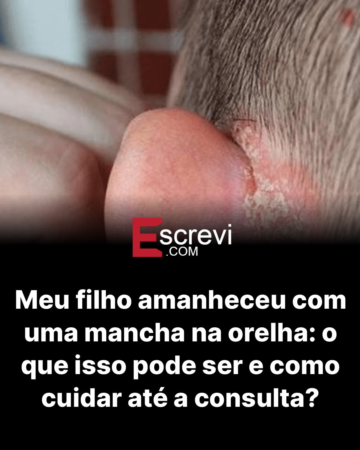 Meu filho amanheceu com uma mancha na orelha: o que isso pode ser e como cuidar até a consulta? card preto