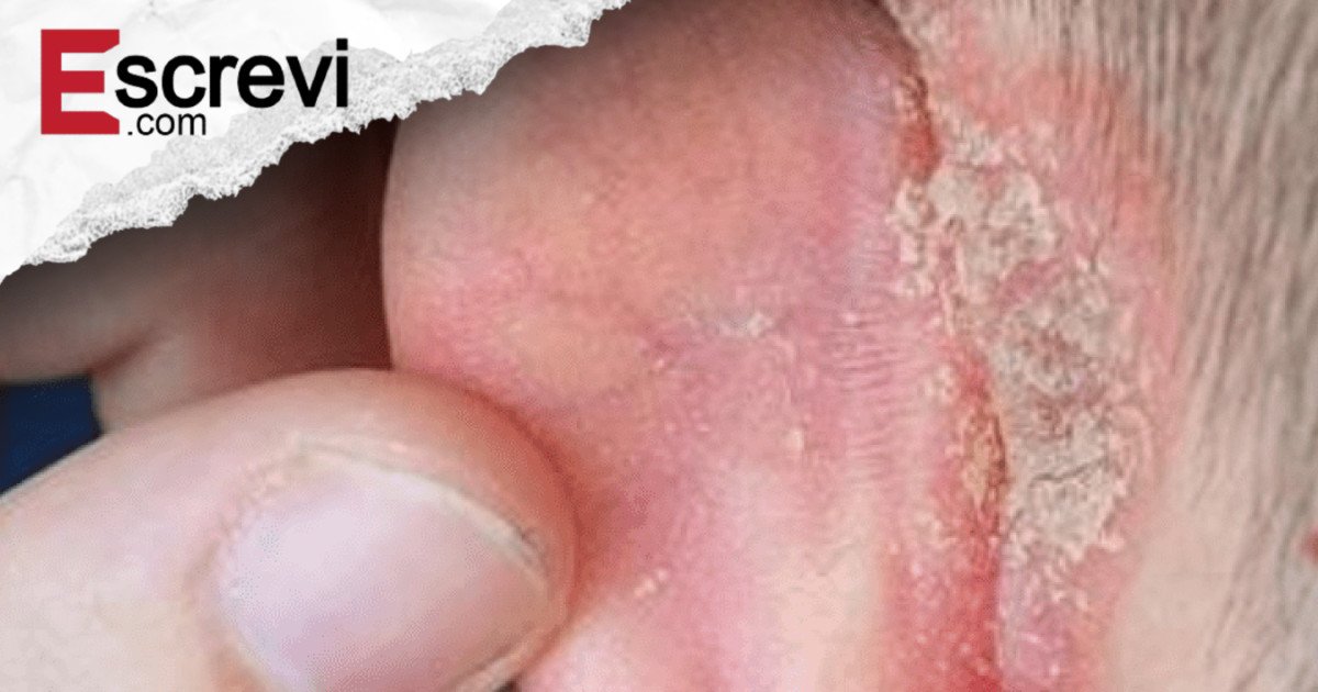 Meu filho amanheceu com uma mancha na orelha: o que isso pode ser e como cuidar até a consulta? imagem principal