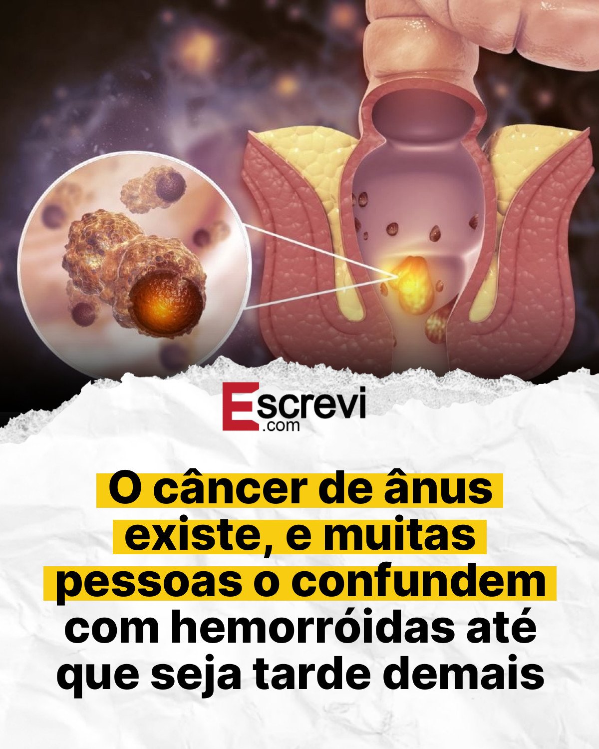 O câncer de ânus existe, e muitas pessoas o confundem com hemorróidas até que seja tarde demais card branco