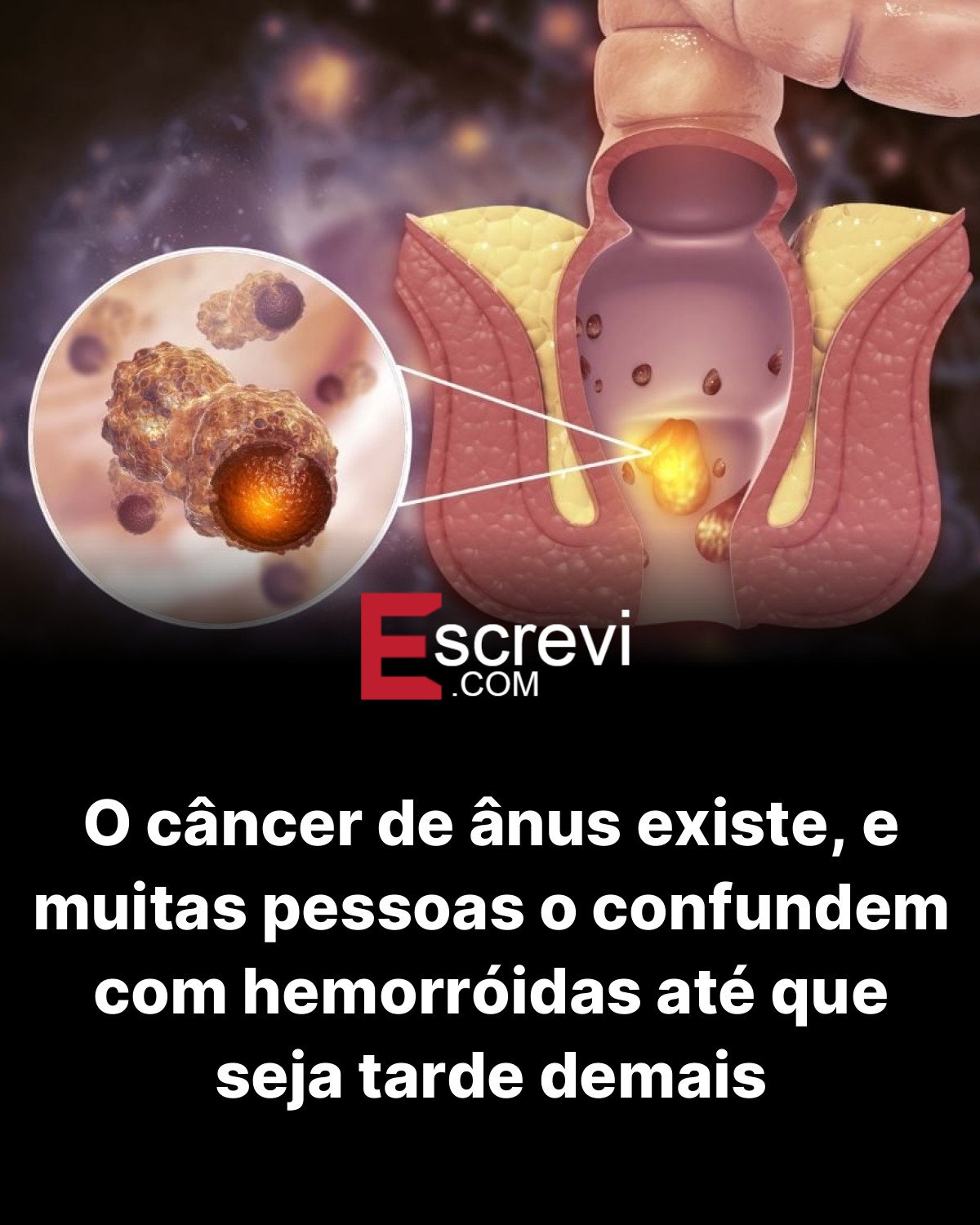 O câncer de ânus existe, e muitas pessoas o confundem com hemorróidas até que seja tarde demais card preto
