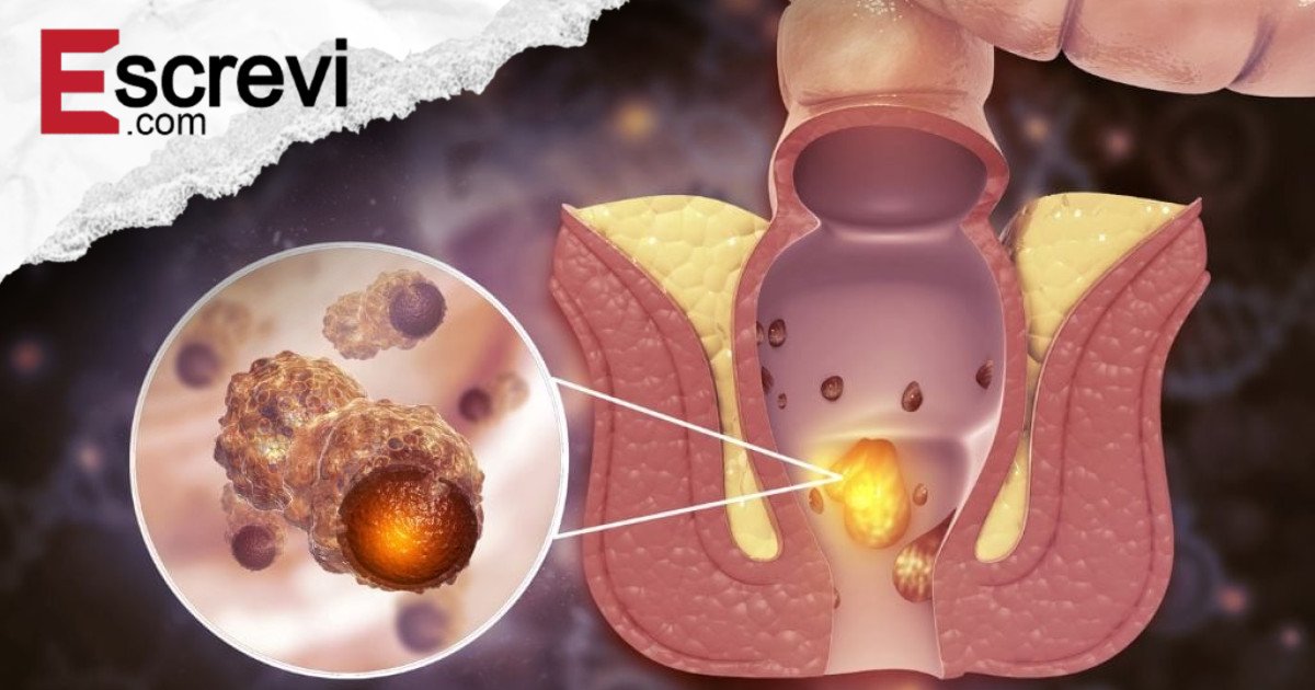 O câncer de ânus existe, e muitas pessoas o confundem com hemorróidas até que seja tarde demais imagem principal