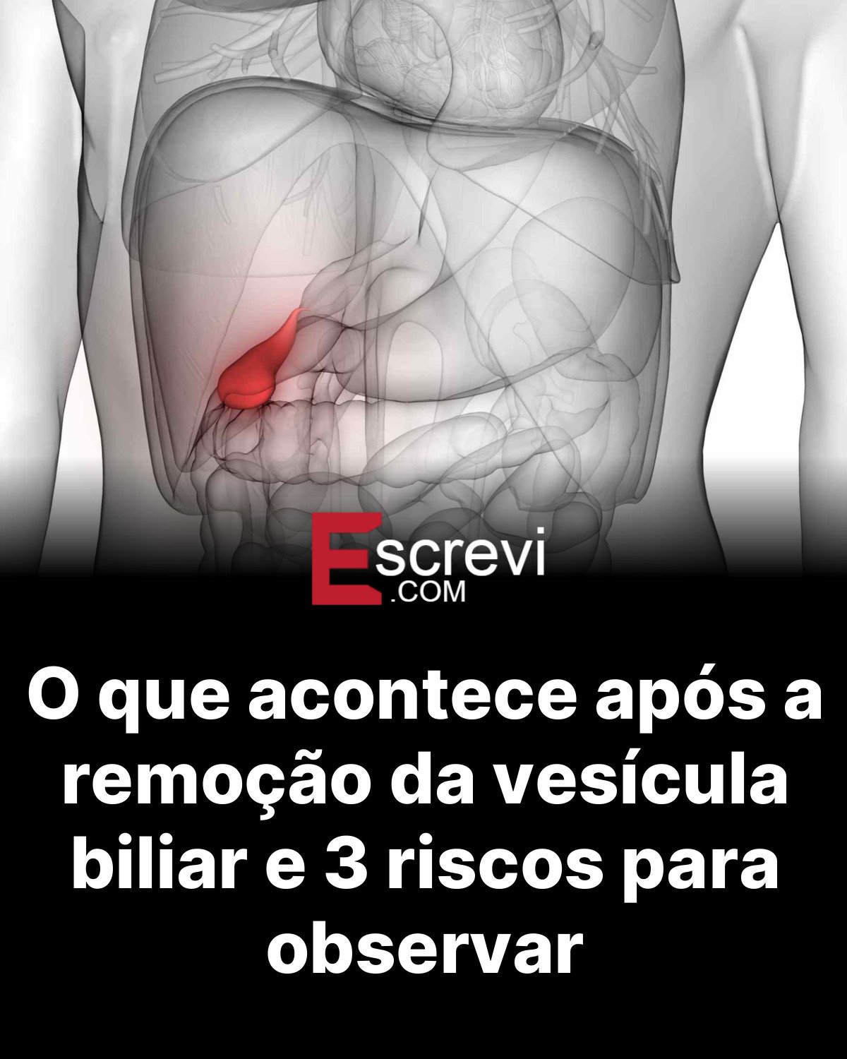 O que acontece após a remoção da vesícula biliar e 3 riscos para observar card preto