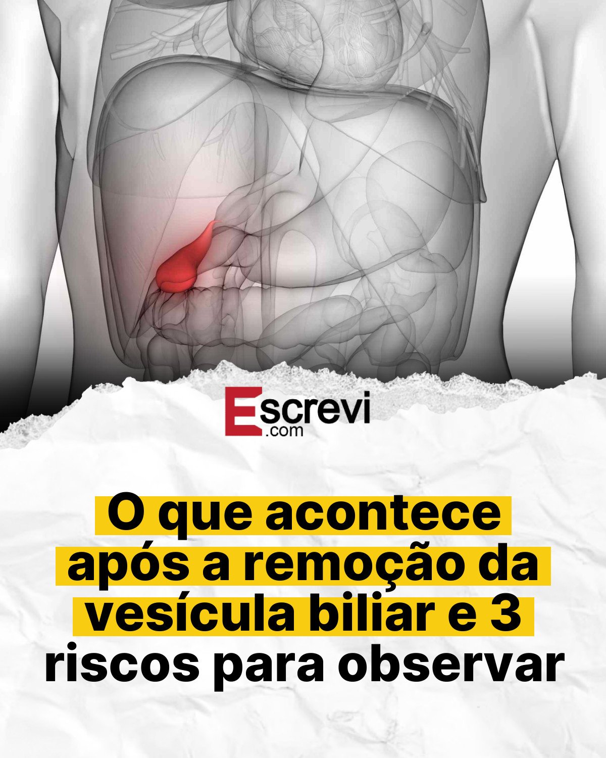 O que acontece após a remoção da vesícula biliar e 3 riscos para observar card branco