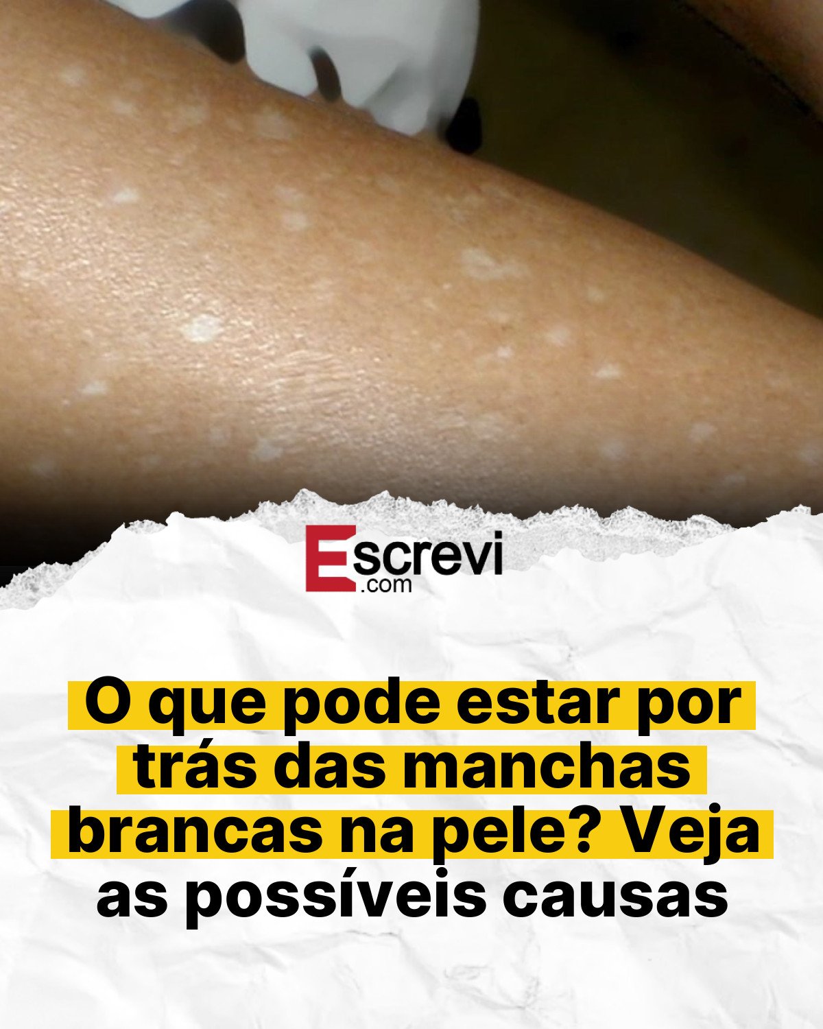 O que pode estar por trás das manchas brancas na pele? Veja as possíveis causas card branco