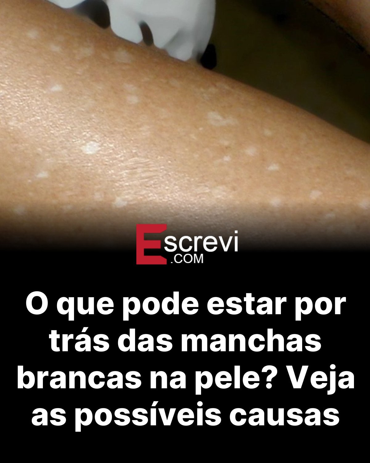 O que pode estar por trás das manchas brancas na pele? Veja as possíveis causas card preto