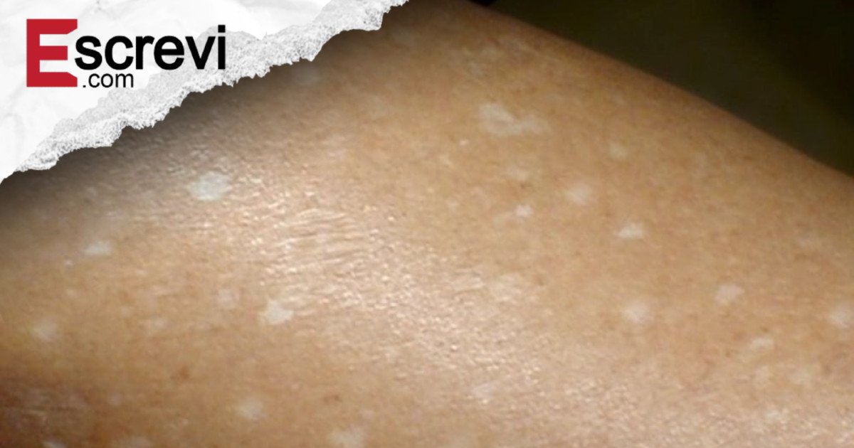 O que pode estar por trás das manchas brancas na pele? Veja as possíveis causas imagem principal