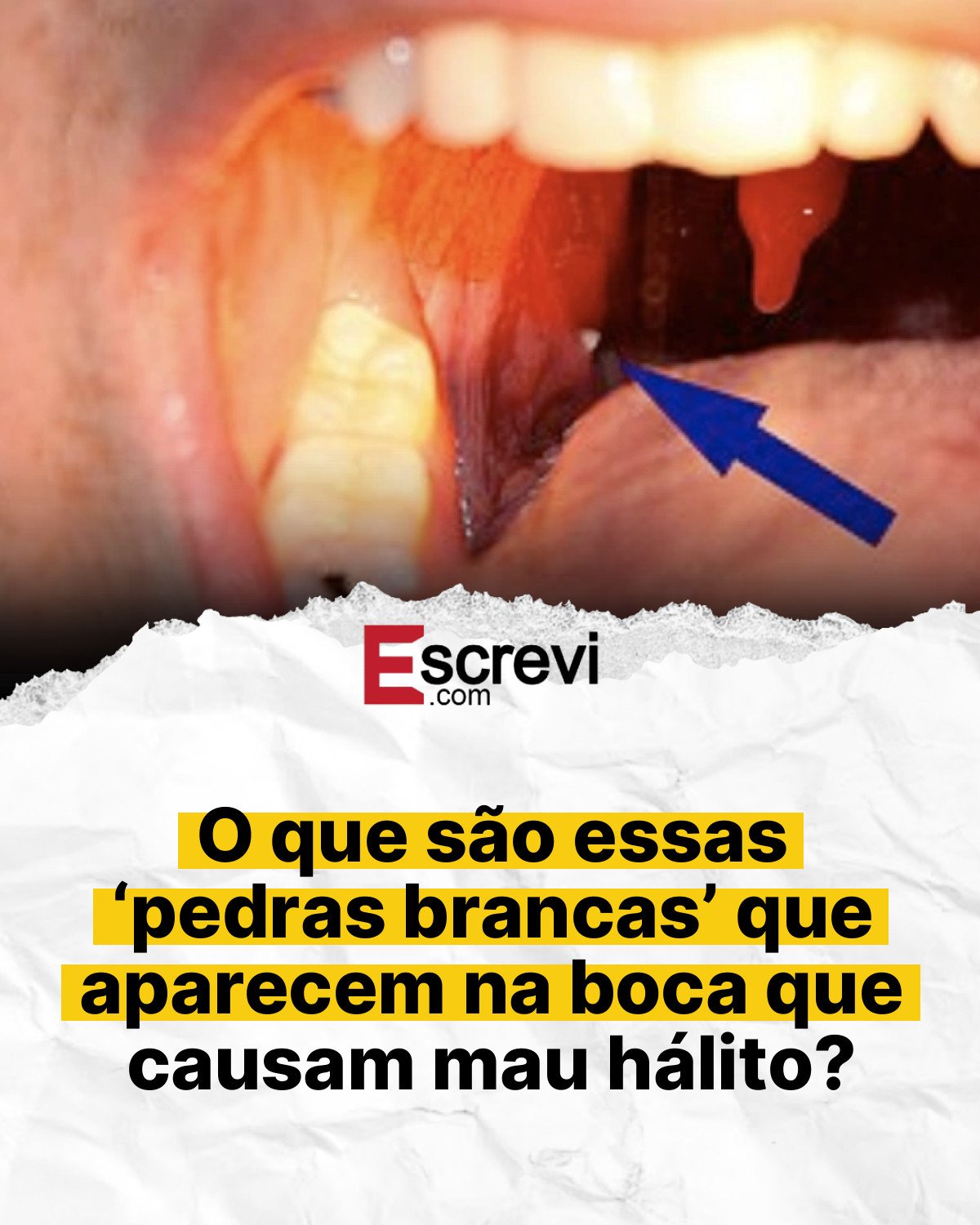 O que são essas ‘pedras brancas’ que aparecem na boca que causam mau hálito? card branco