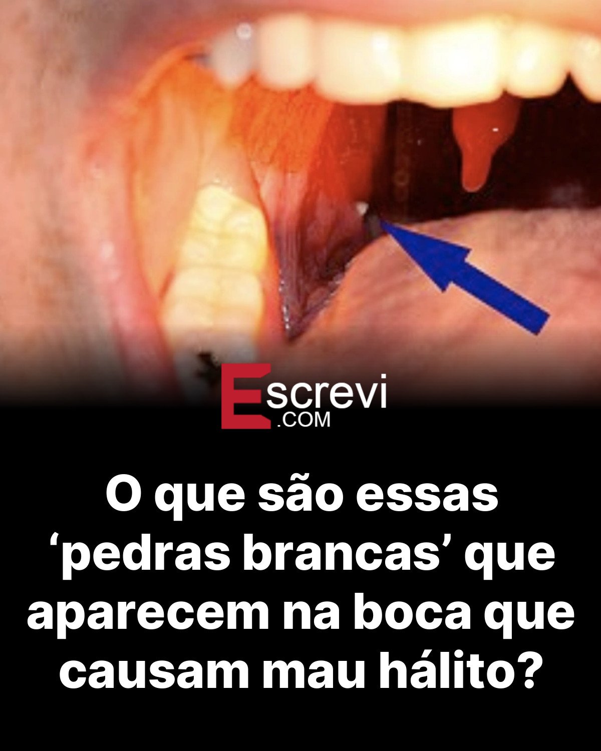 O que são essas ‘pedras brancas’ que aparecem na boca que causam mau hálito? card preto