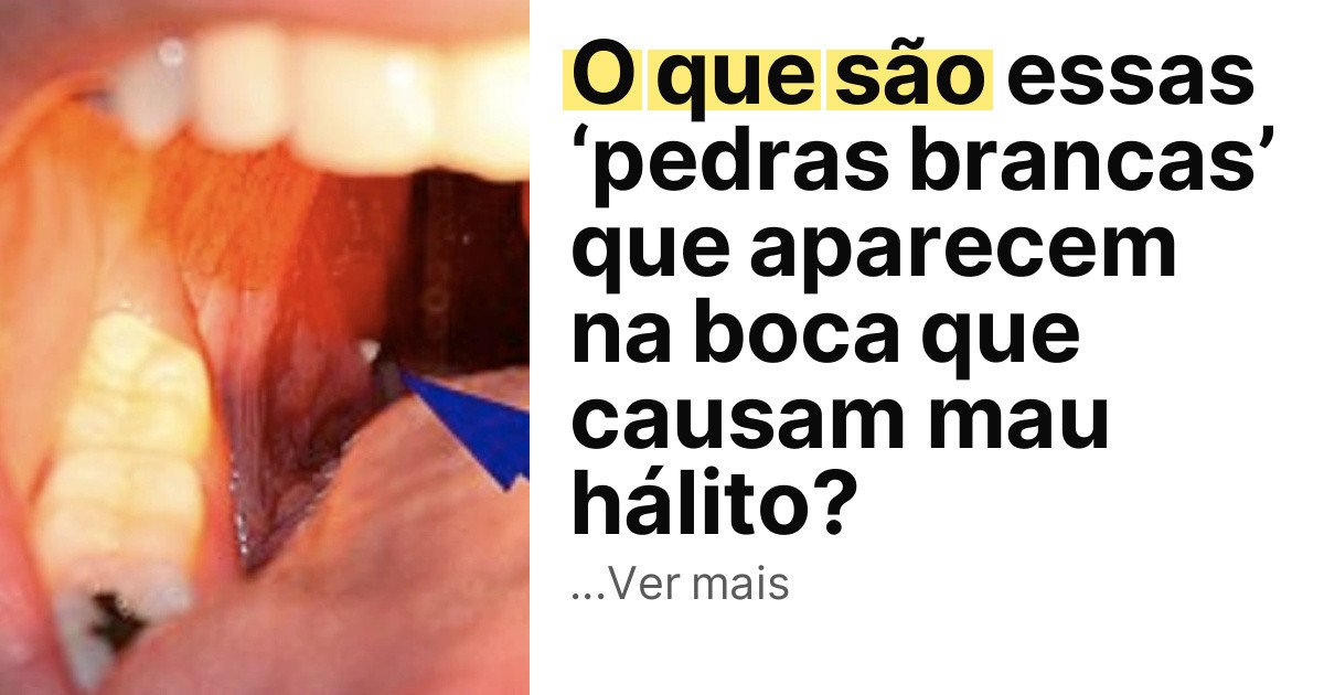O que são essas ‘pedras brancas’ que aparecem na boca que causam mau hálito? imagem principal