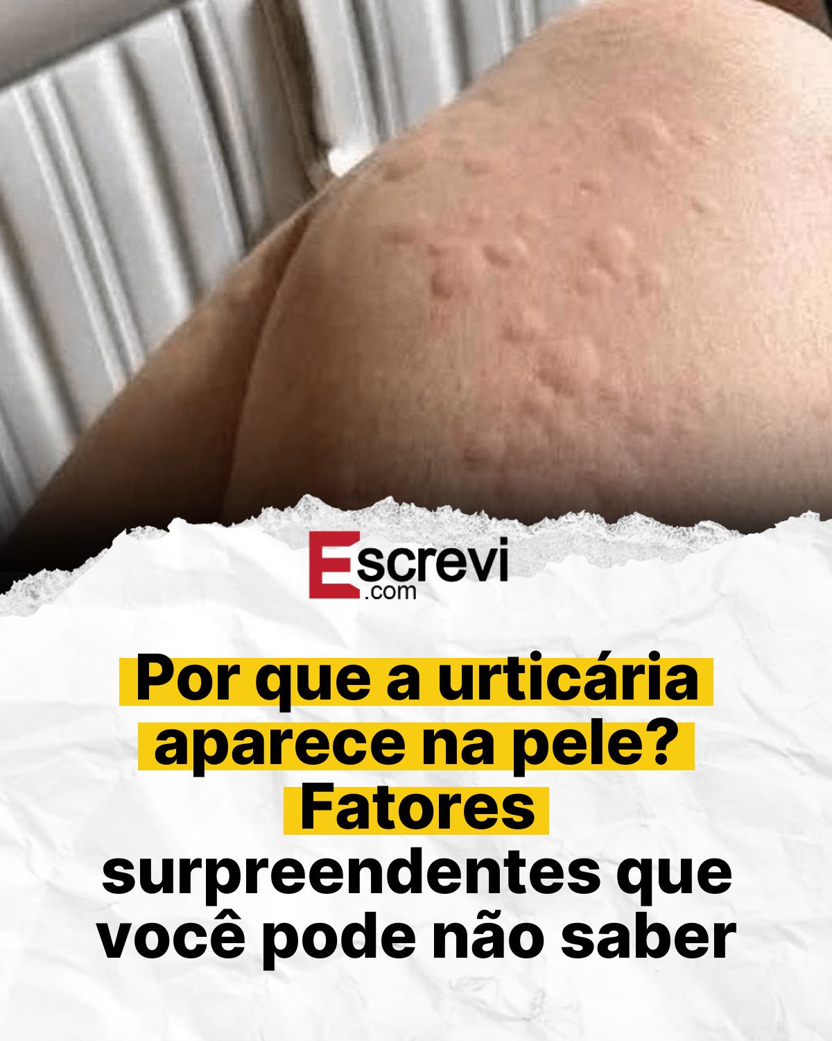 Por que a urticária aparece na pele? Fatores surpreendentes que você pode não saber card branco