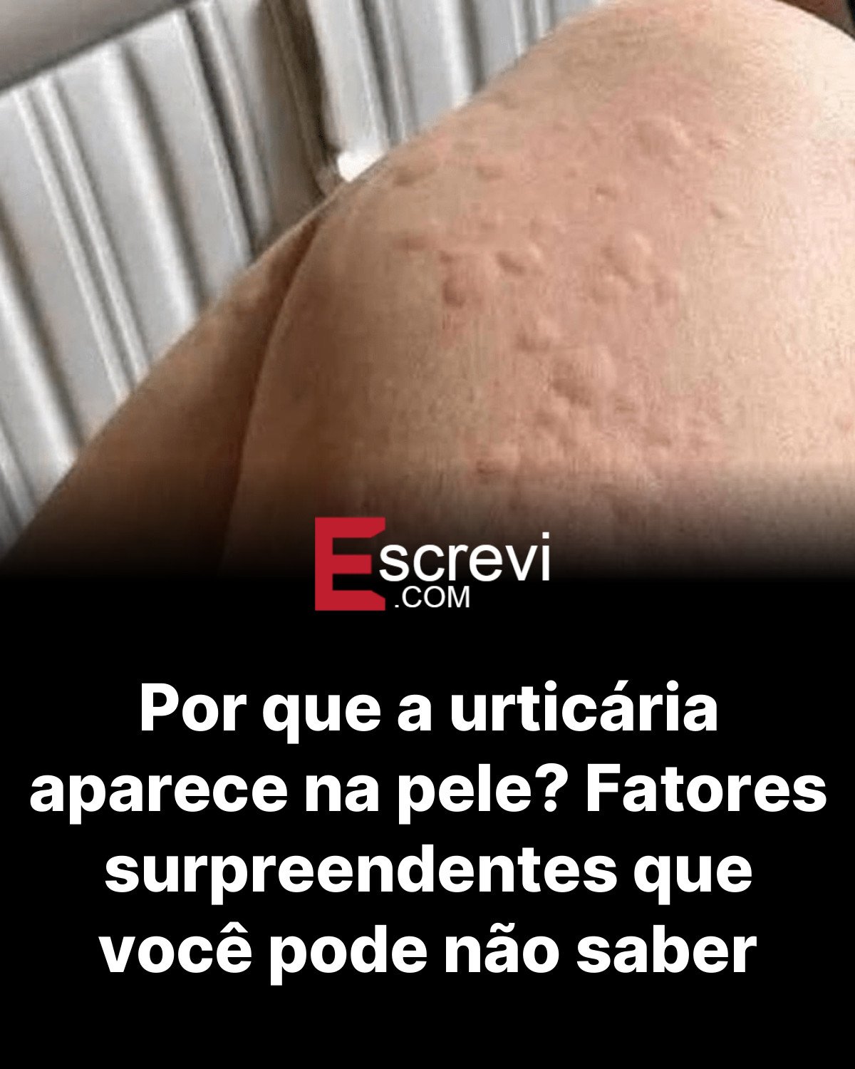Por que a urticária aparece na pele? Fatores surpreendentes que você pode não saber card preto