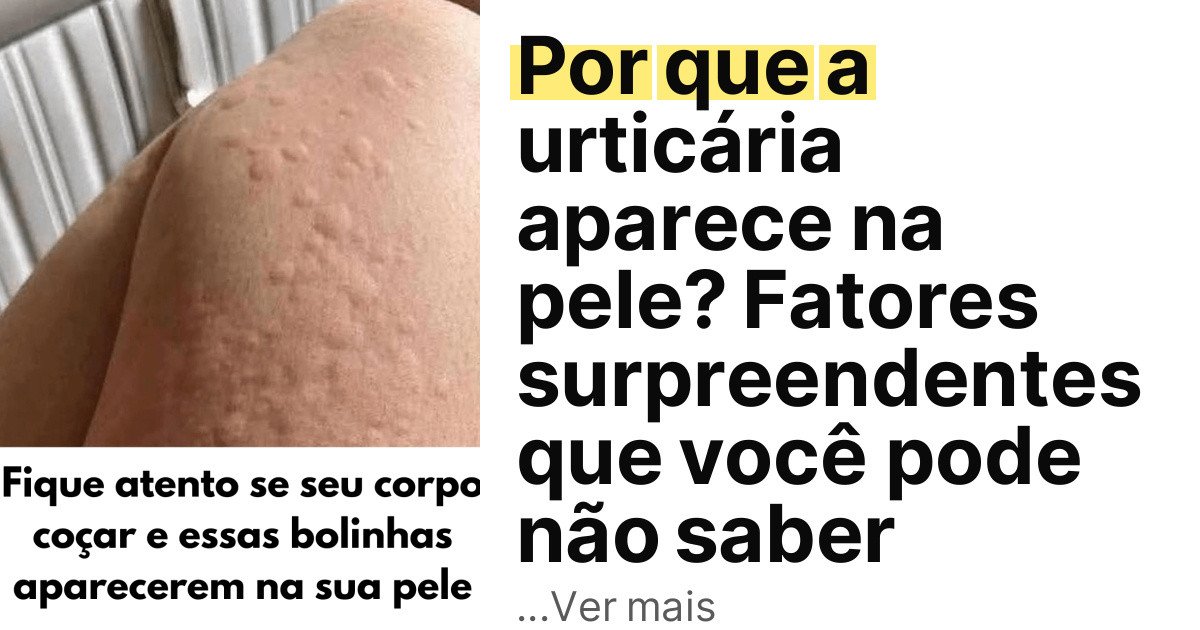 Por que a urticária aparece na pele? Fatores surpreendentes que você pode não saber imagem principal