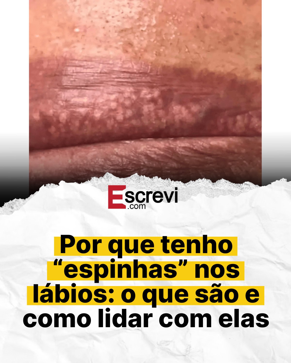 Por que tenho “espinhas” nos lábios: o que são e como lidar com elas card branco