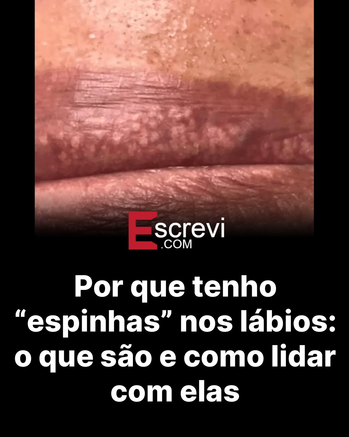 Por que tenho “espinhas” nos lábios: o que são e como lidar com elas card preto