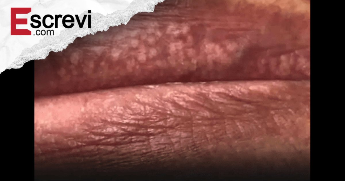 Por que tenho “espinhas” nos lábios: o que são e como lidar com elas imagem principal