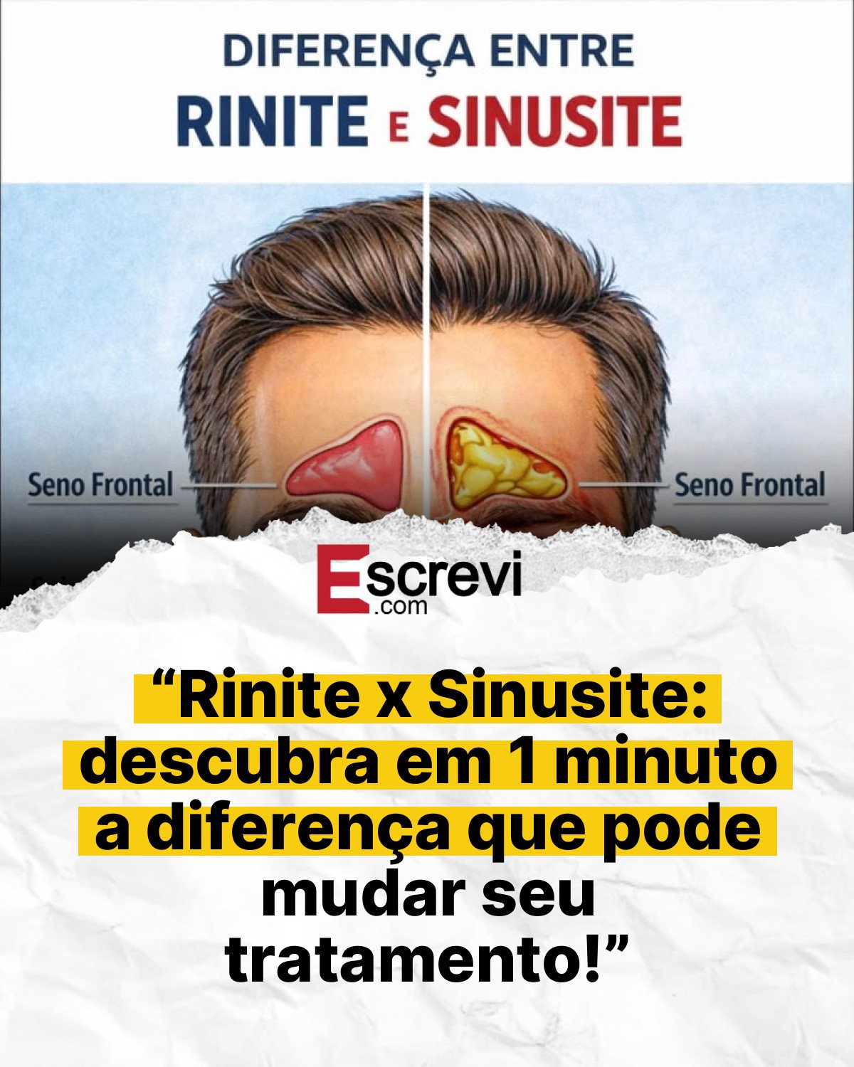 “Rinite x Sinusite: descubra em 1 minuto a diferença que pode mudar seu tratamento!” card branco