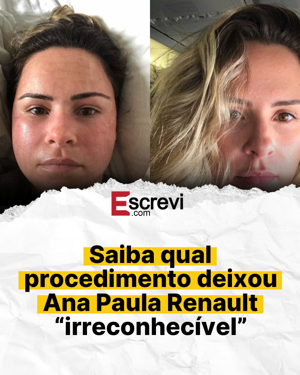 Saiba qual procedimento deixou Ana Paula Renault “irreconhecível” card branco