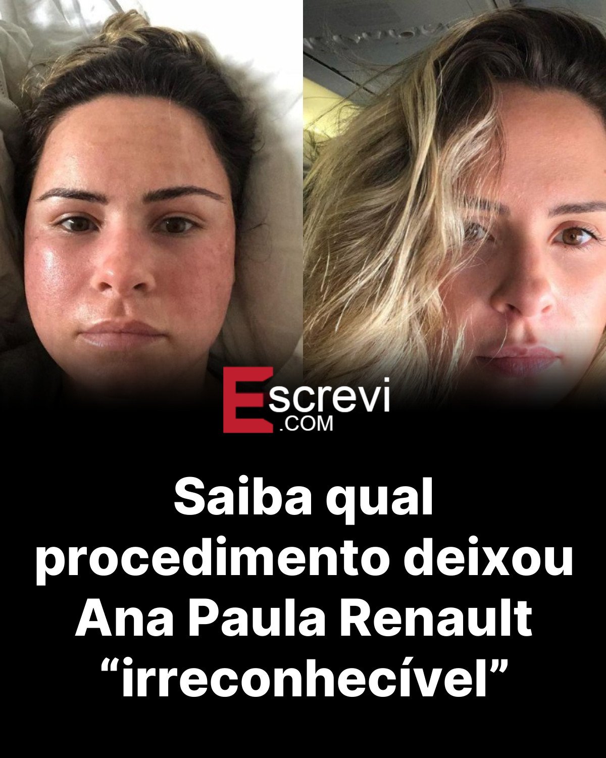 Saiba qual procedimento deixou Ana Paula Renault “irreconhecível” card preto