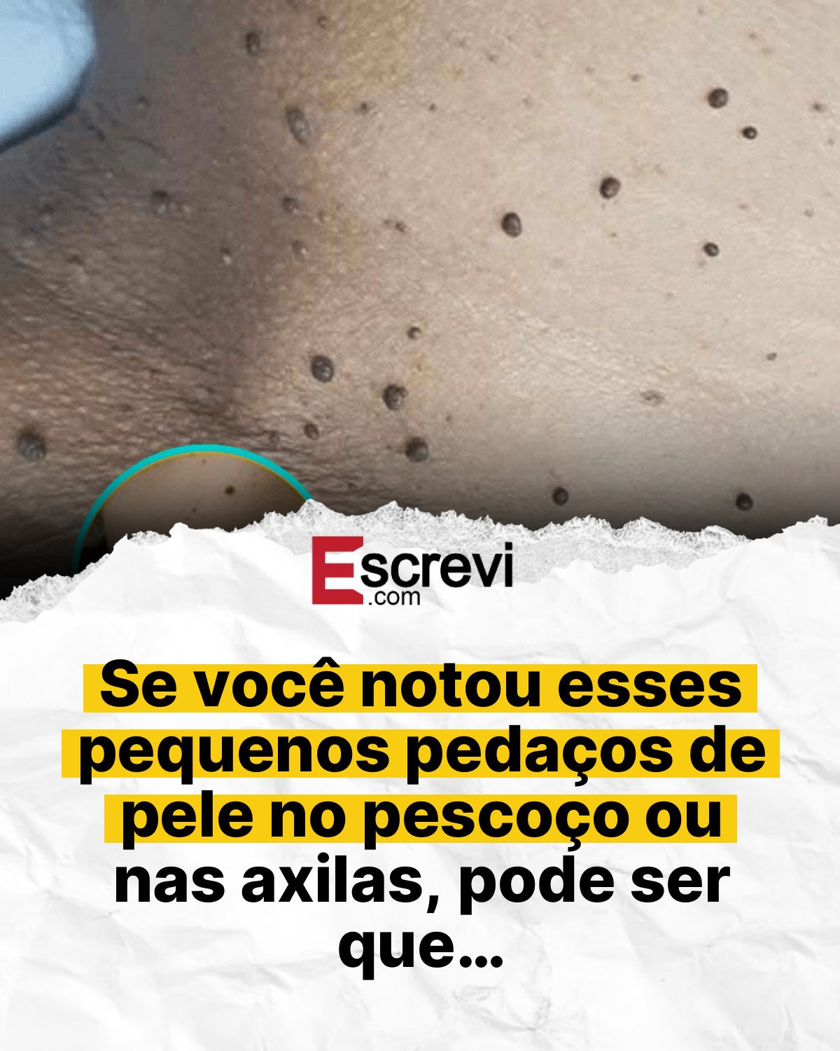 Se você notou esses pequenos pedaços de pele no pescoço ou nas axilas, pode ser que… card branco