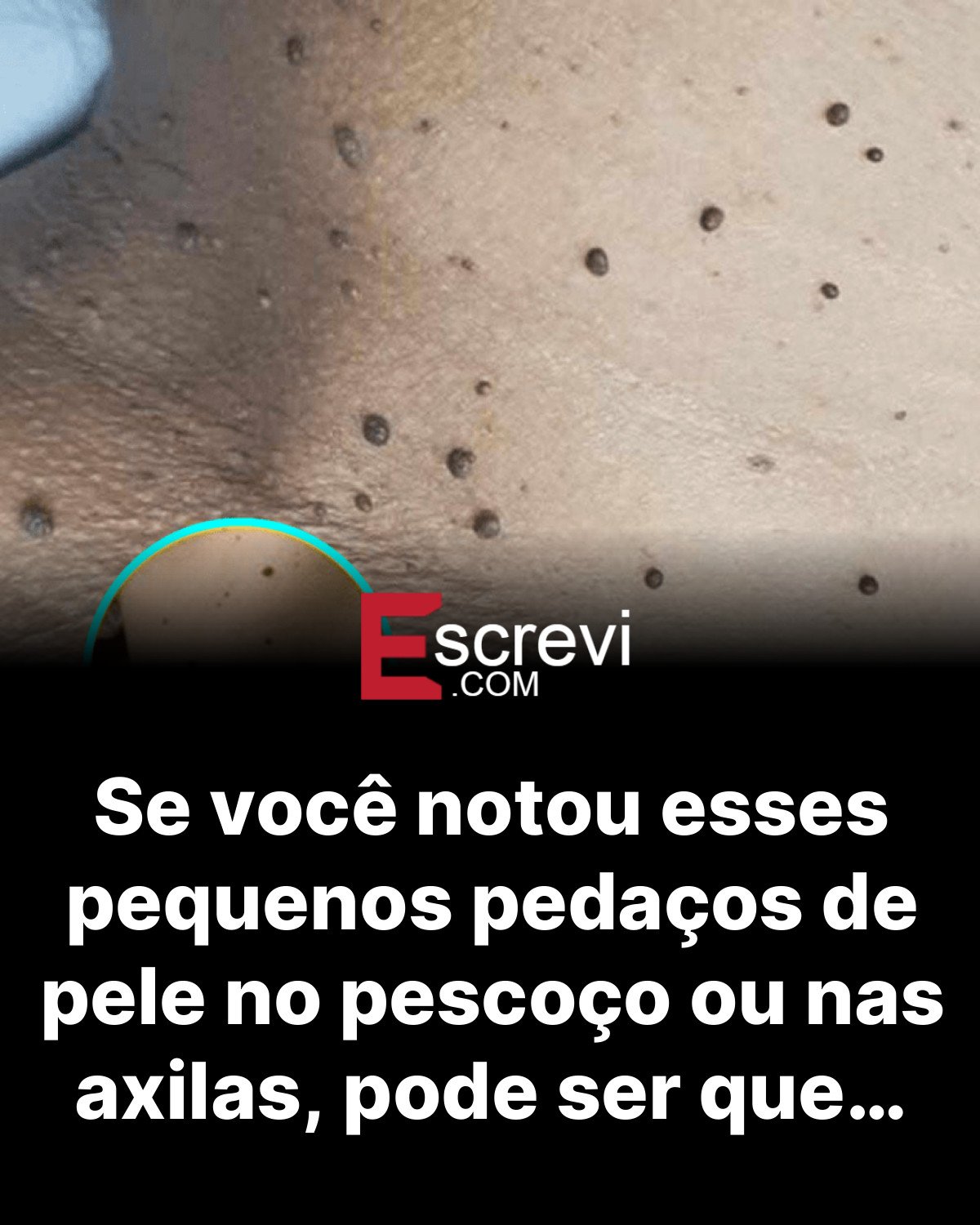 Se você notou esses pequenos pedaços de pele no pescoço ou nas axilas, pode ser que… card preto