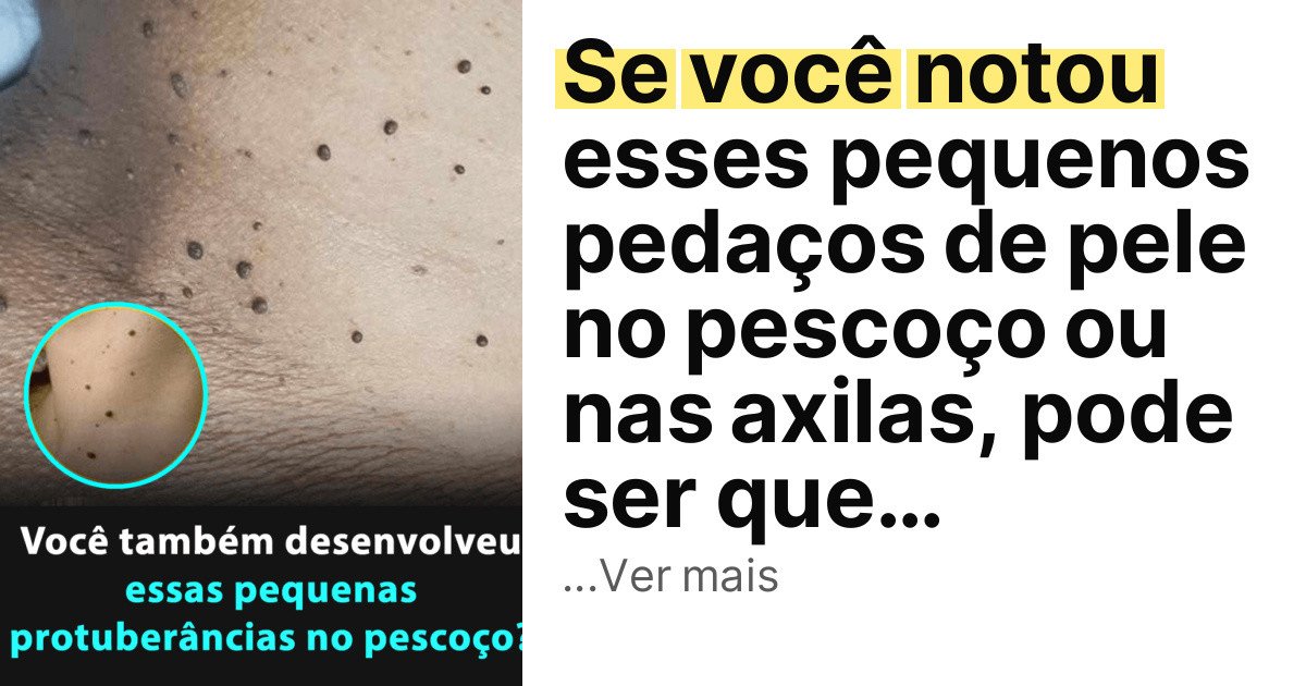 Se você notou esses pequenos pedaços de pele no pescoço ou nas axilas, pode ser que… imagem principal