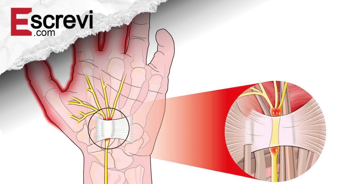 Suas mãos ficam dormentes com frequência? Descubra o que pode estar por trás desse sintoma, as possíveis doenças associadas e os melhores remédios naturais imagem principal
