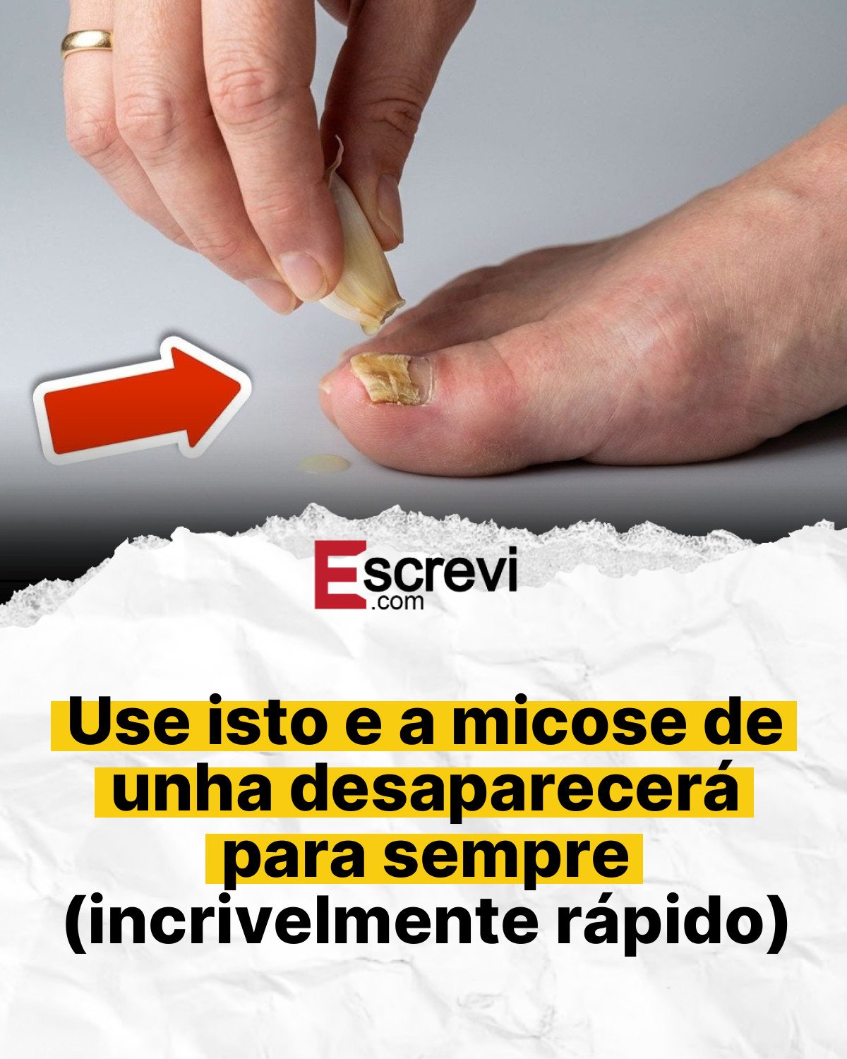 Use isto e a micose de unha desaparecerá para sempre (incrivelmente rápido) card branco